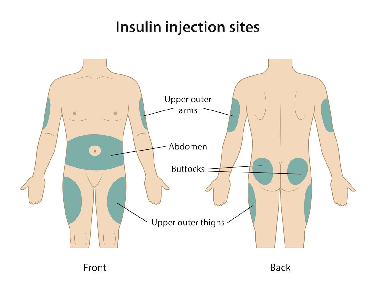 b12 injection sites thigh File:Injection Sites Intramuscular Thigh Adult.png